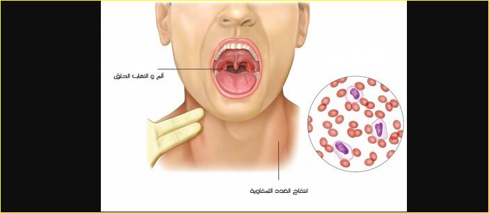 فيروس EBV