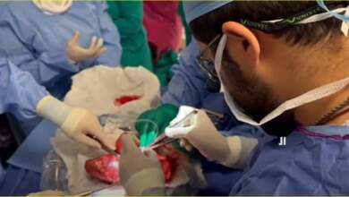 من داخل غرفة العمليات إجراء جراحة زرع فصى رئة لمريضة فى مصر