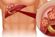 أورام الكبد السرطانية