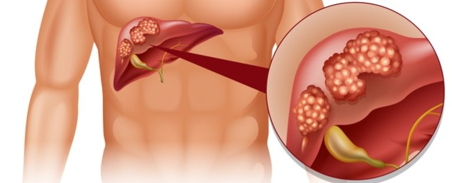 أورام الكبد السرطانية